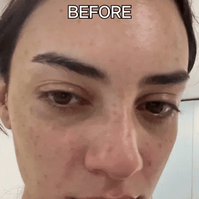 Aplicación de la crema Nítida en el rostro